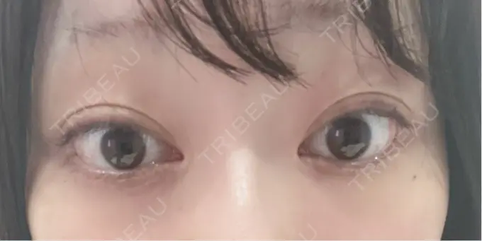 ヒアルロン酸注入（涙袋） / ボトックス（タレ目） アネシス美容クリニック BEFORE メイン用