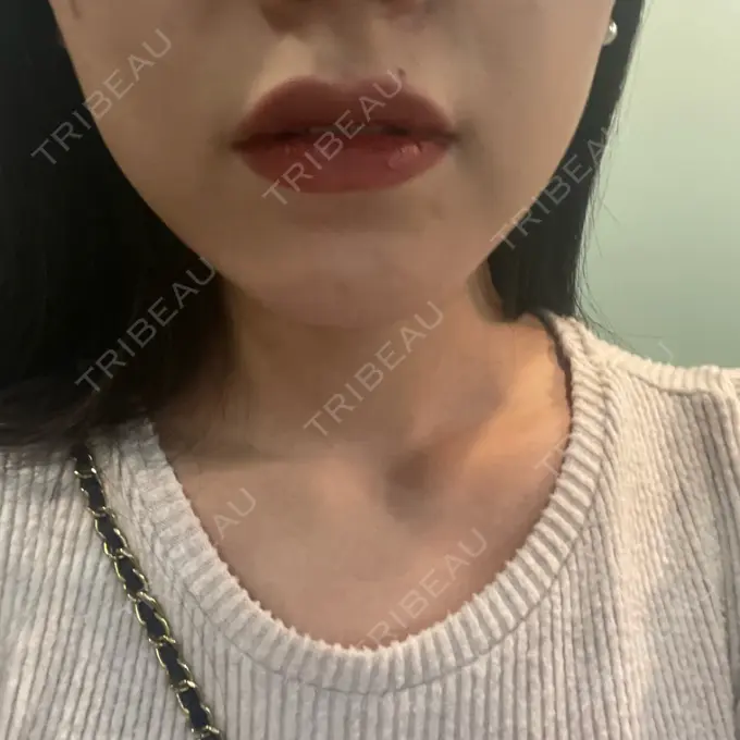 ハイフ（顔） エースクリニック 大阪梅田HEPナビオ院 BEFORE メイン用