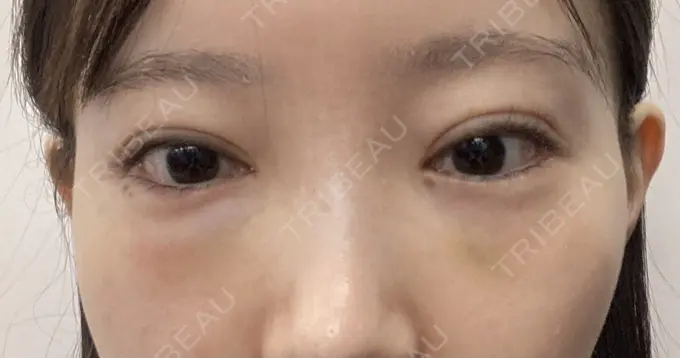 ヒアルロン酸溶解 EOL CLINIC【オルクリニック】 BEFORE メイン用