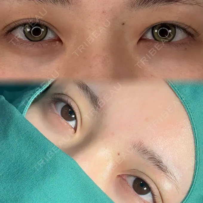 二重埋没 / ヒアルロン酸注入（唇） アリエル美容クリニック 横浜院 BEFORE メイン用