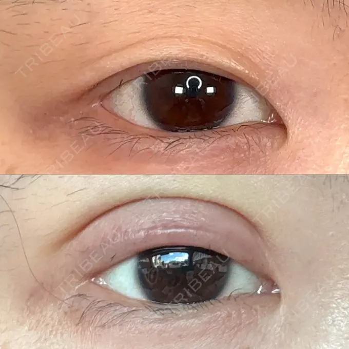 二重埋没 / ボトックス（あご） / ヒアルロン酸注入（あご） / ボトックス（エラ・小顔） アリエル美容クリニック 水戸院 BEFORE メイン用