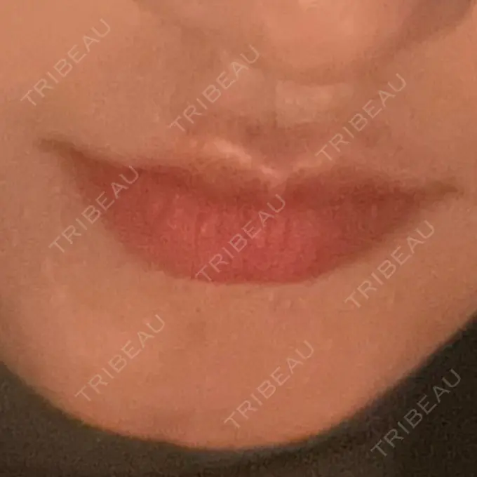 ヒアルロン酸注入（唇） / ボトックス（口角） ルラ美容クリニック 高田馬場院 BEFORE メイン用