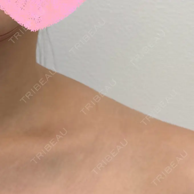 ボトックス（エラ・小顔） / ボトックス（肩） Next Tokyo Clinic BEFORE メイン用