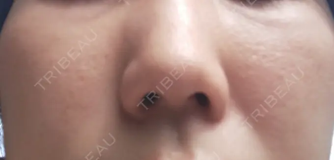 プラセンタ注射 東京美容外科 福岡院 BEFORE メイン用