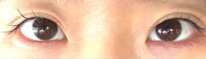 上まぶたたるみ取り / 目元修正 BIANCA銀座 BEFORE メイン用