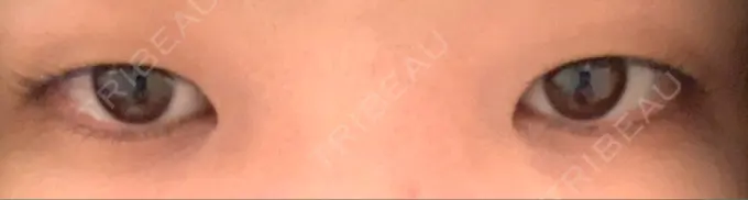 二重埋没 湘南美容クリニック 二子玉川院 BEFORE メイン用