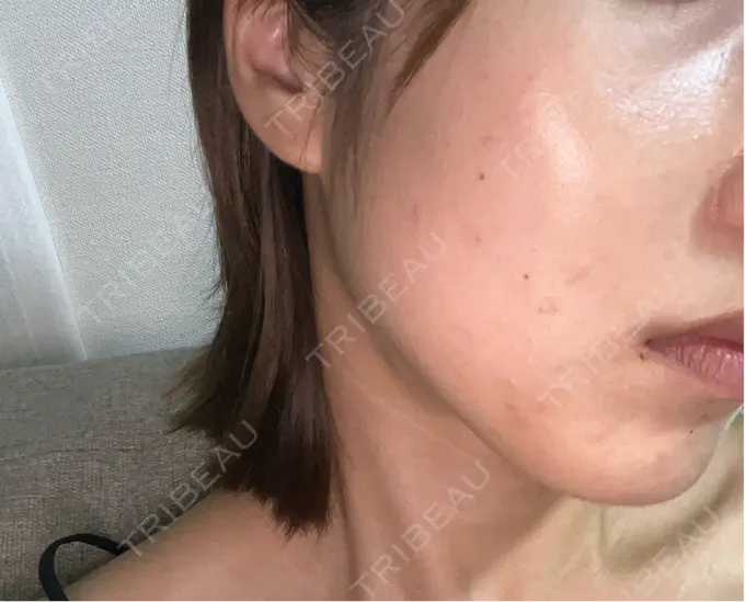 ボトックス（エラ・小顔） 共立美容外科 立川院 BEFORE メイン用