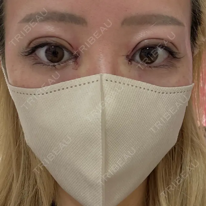 二重埋没 / 目頭切開 eクリニック 福岡院 BEFORE メイン用