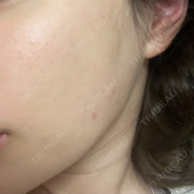 ショッピングリフト BAO CLINIC 心斎橋院 BEFORE メイン用