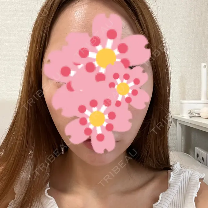 糸リフト MAクリニック 心斎橋 BEFORE メイン用