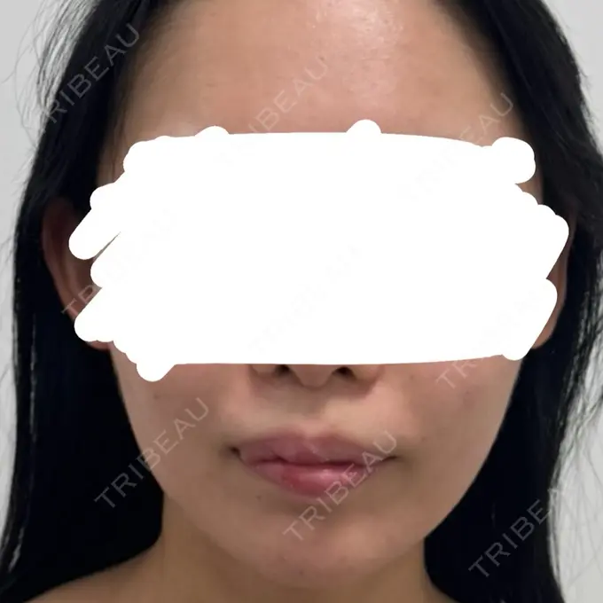 糸リフト / 脂肪吸引（顔） / ジョールファット除去 / 脂肪吸引注射（顔） SEA CLINIC（シークリニック） BEFORE メイン用