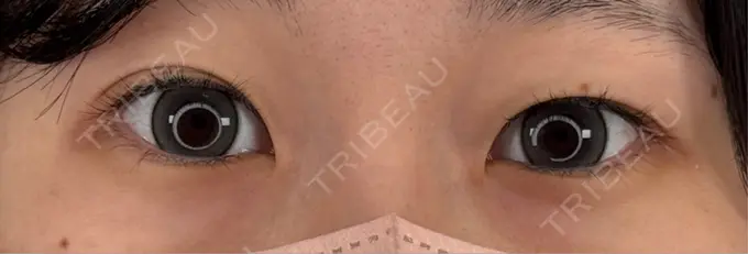 二重埋没 / 小鼻縮小（非切開） / ヒアルロン酸注入（涙袋） アリエル美容クリニック 横浜院 BEFORE メイン用