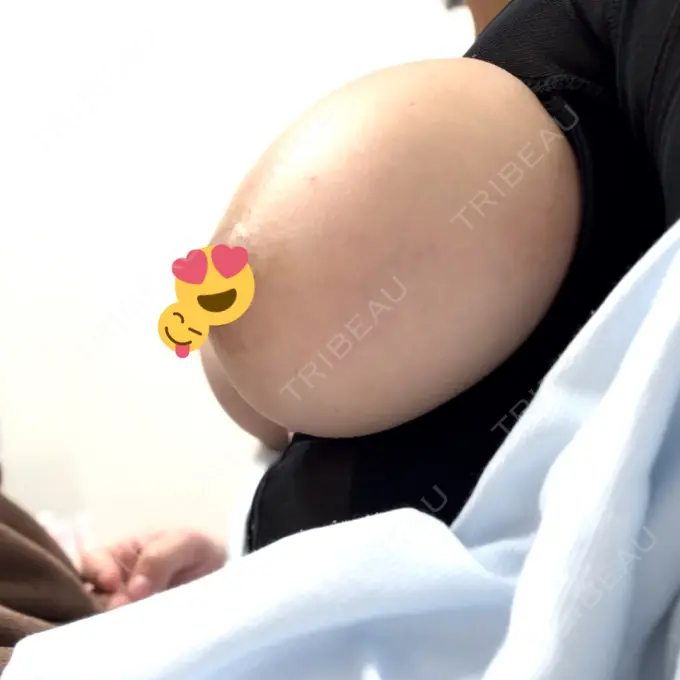 豊胸（シリコンバッグ） ルーチェクリニック 銀座院 BEFORE メイン用