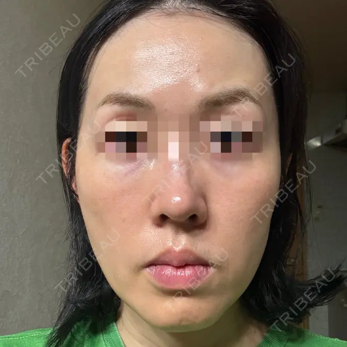 美容点滴・美容注射（美肌） / 白玉点滴・注射 / 美肌レーザー / シミ取りレーザー / 美白レーザー / ピコレーザートーニング（美白・肝斑） / レーザートーニング（美白・肝斑） LE CLINIC BEFORE メイン用