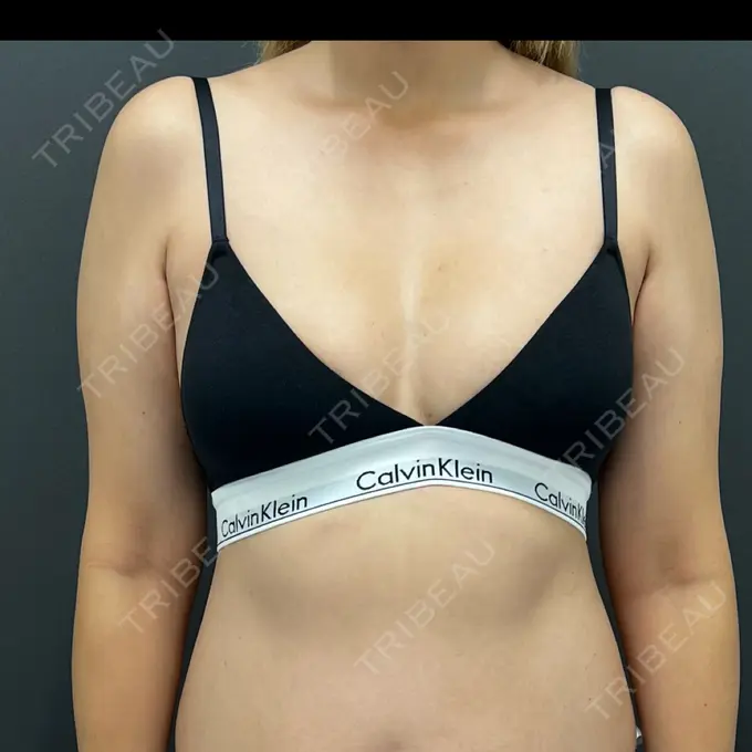 豊胸（脂肪注入） plume clinic BEFORE メイン用