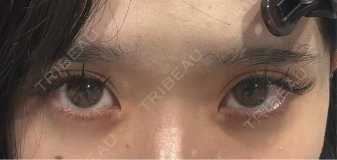 二重埋没 R Beauty CLINIC 銀座院 BEFORE メイン用