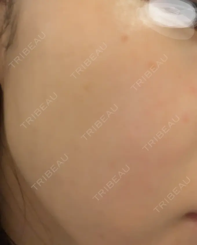 ベビーコラーゲン 椿クリニック 心斎橋院 BEFORE メイン用