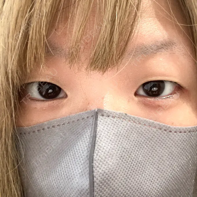 二重埋没 アリエル美容クリニック 横浜院 BEFORE メイン用