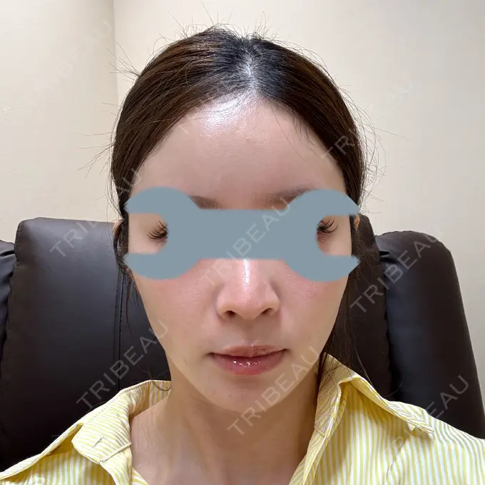 ボトックス（眉間） / ボトックス（額） / ヒアルロン酸注入（鼻翼基部） FIG CLINIC BEFORE メイン用