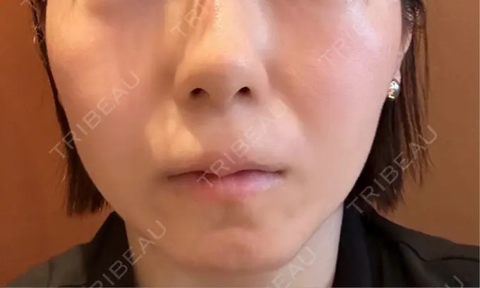 ボトックス（エラ・小顔） PRISM Beauty Clinic 町田院 BEFORE メイン用