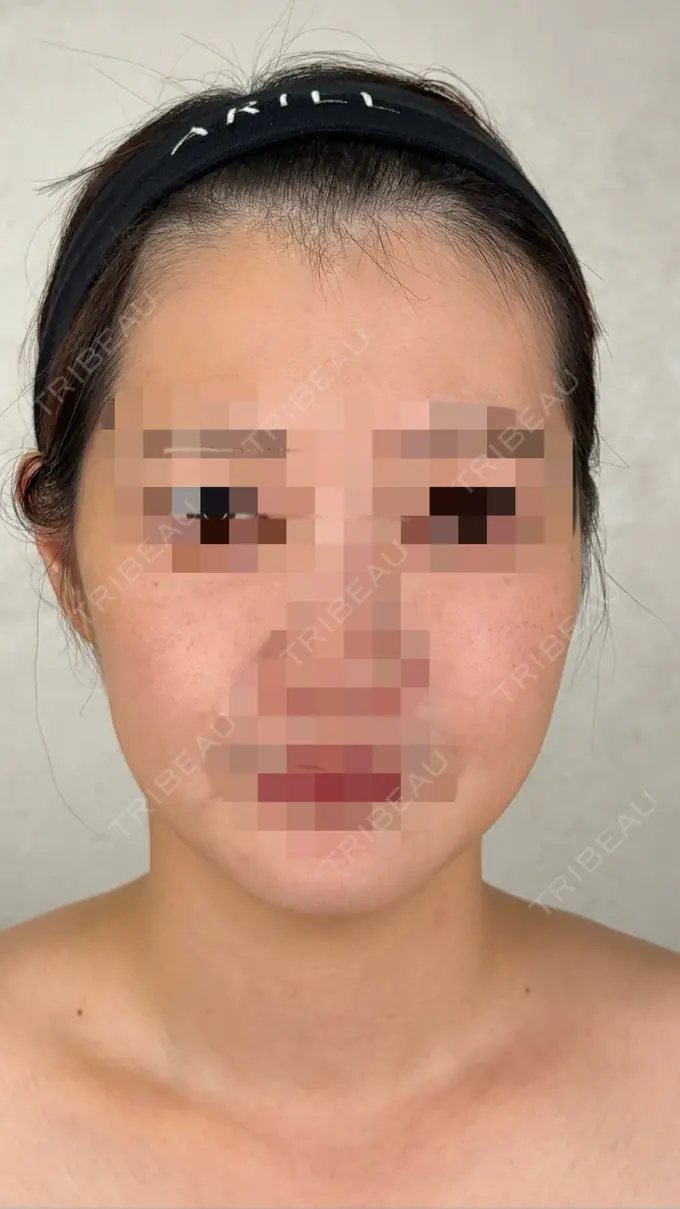 二重埋没 / 糸リフト アリエル美容クリニック 横浜院 BEFORE メイン用
