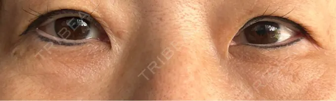 目頭切開 / 下まぶたたるみ取り eクリニック 福岡院 BEFORE メイン用