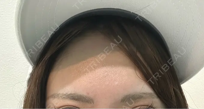 アートメイク除去・修正 ライズワン美容皮膚科クリニック BEFORE メイン用