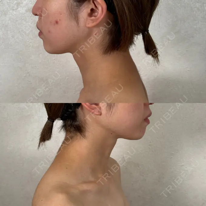 糸リフト / 脂肪吸引（顔） / ジョールファット除去 アリエル美容クリニック 横浜院 BEFORE メイン用