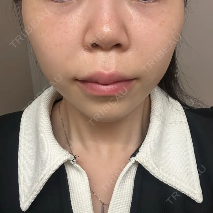 人中短縮 / ヒアルロン酸注入（目の下） / RF（高周波）たるみ治療 BITO BEAUTY CLINIC BEFORE メイン用