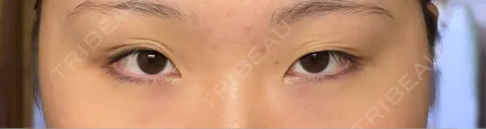 二重埋没 R Beauty CLINIC 銀座院 BEFORE メイン用