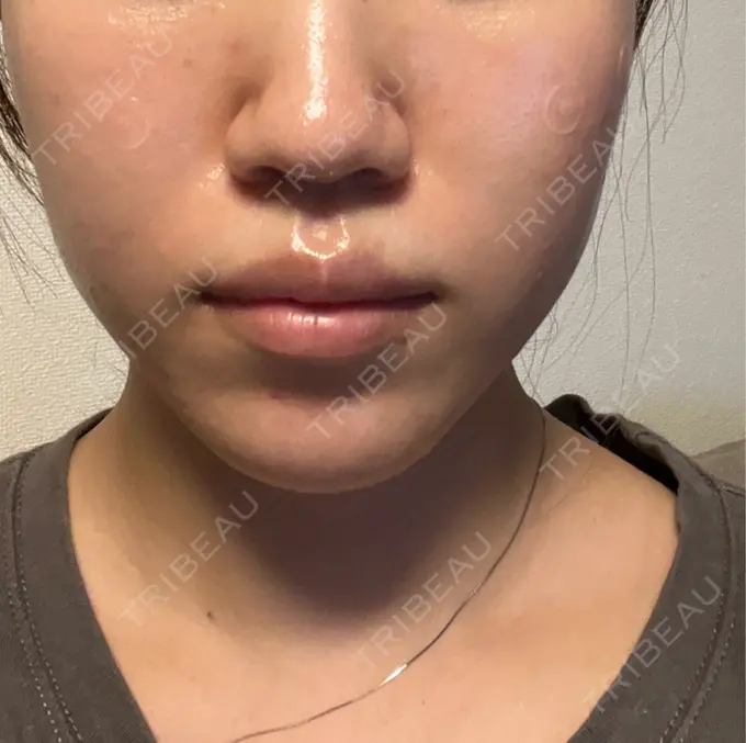 ボトックス（エラ・小顔） / ワキ汗治療（ボトックス） アリエル美容クリニック 横浜院 BEFORE メイン用