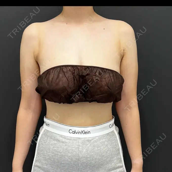 脂肪吸引（二の腕） / 脂肪吸引（肩） plume clinic BEFORE メイン用