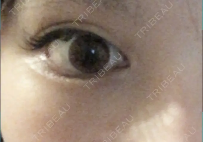 ヒアルロン酸注入（涙袋） 池田クリニック 大阪院 BEFORE メイン用