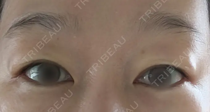 眉下切開 もとび美容外科クリニック 新宿院 BEFORE メイン用