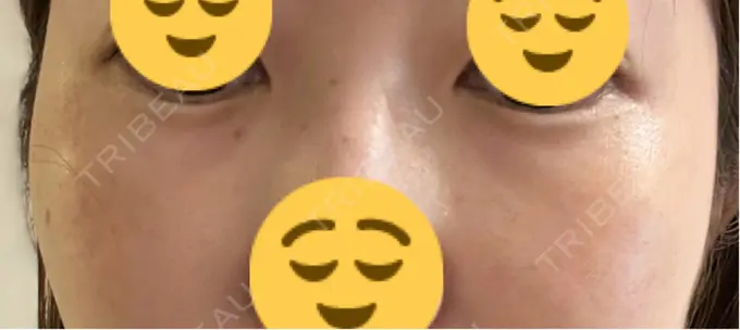 下まぶたたるみ取り / 脂肪注入（目の下） プラストクリニック BEFORE メイン用