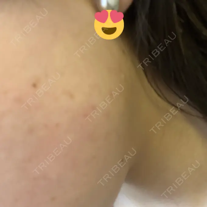 ボトックス（エラ・小顔） 共立美容外科 名古屋院 BEFORE メイン用