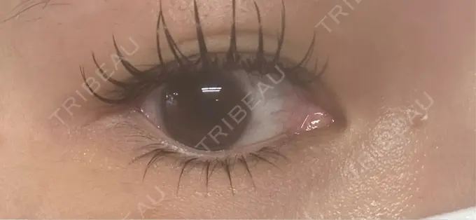 ヒアルロン酸注入（涙袋） フィラークリニック 名古屋栄院 BEFORE メイン用