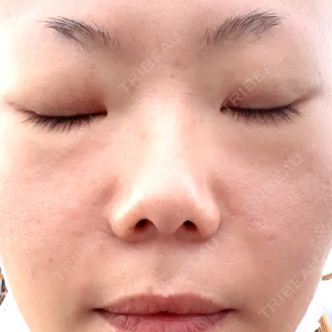 ボトックス（眉間） / その他（輪郭） TCB東京中央美容外科 福岡天神院 BEFORE メイン用