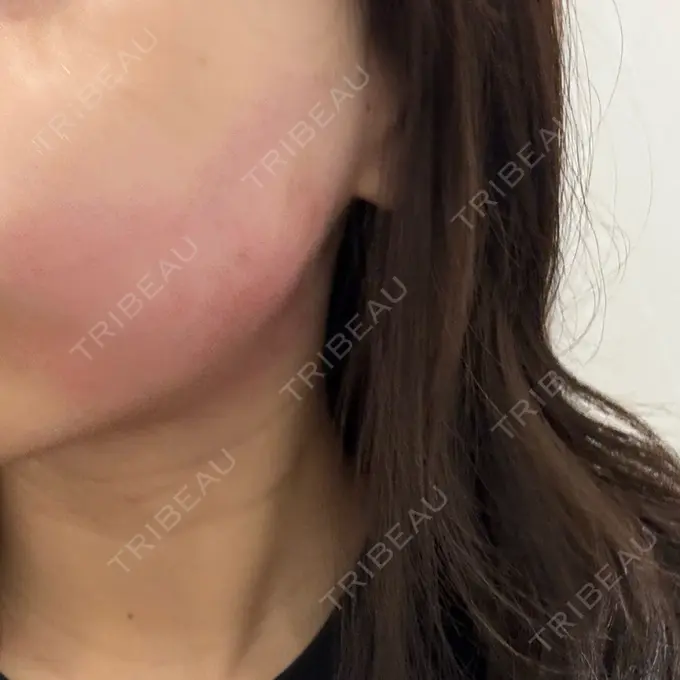 RF（高周波）たるみ治療 ゆきスキンクリニック 東池袋 BEFORE メイン用