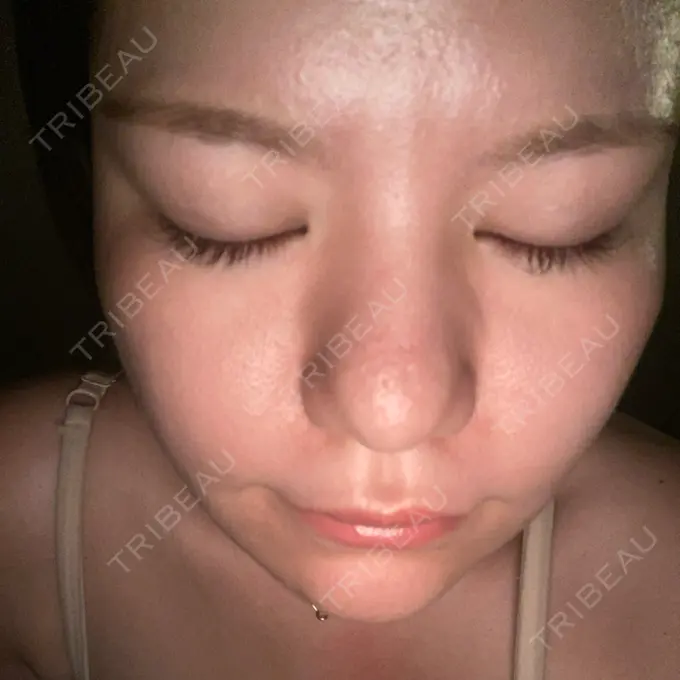 脂肪溶解注射（顔） SK新宿歌舞伎町美容外科・歯科 BEFORE メイン用