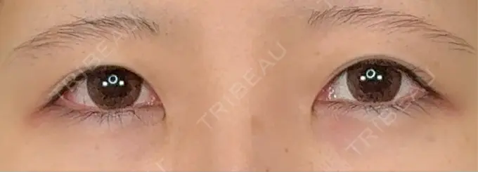 二重埋没 アリエル美容クリニック 水戸院 BEFORE メイン用