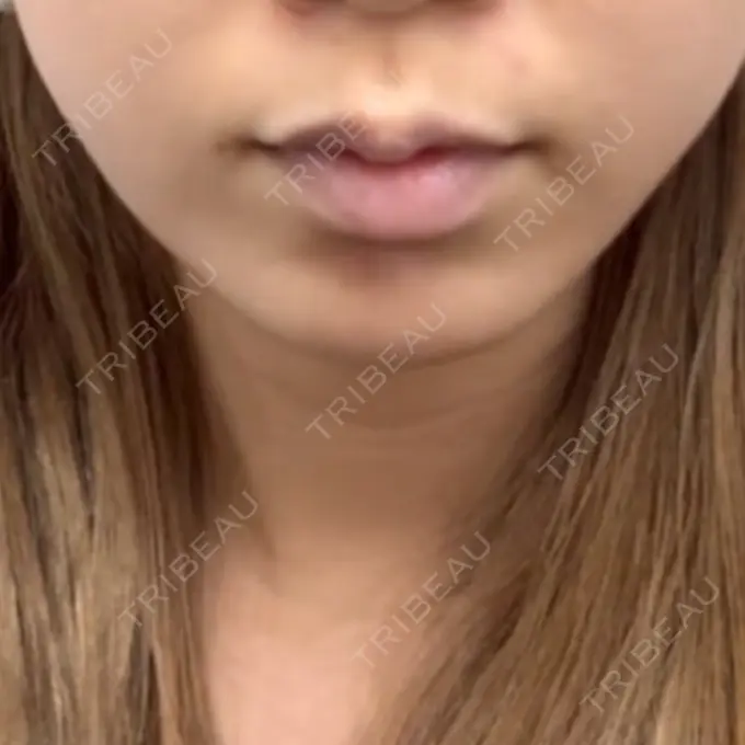 ボトックス（あご） / ヒアルロン酸注入（あご） BITO BEAUTY CLINIC BEFORE メイン用