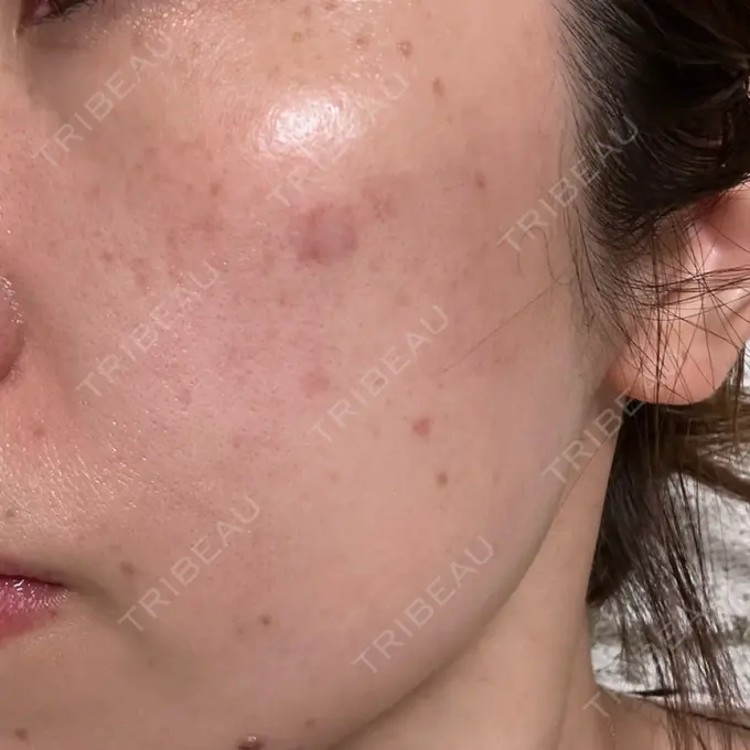 イオン導入 / ピーリング（ハリ・ツヤ） / ルメッカ ルラ美容クリニック 福岡本院 BEFORE メイン用