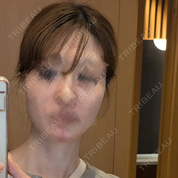 ヒアルロン酸注入（あご） TCB東京中央美容外科 青森院 BEFORE メイン用