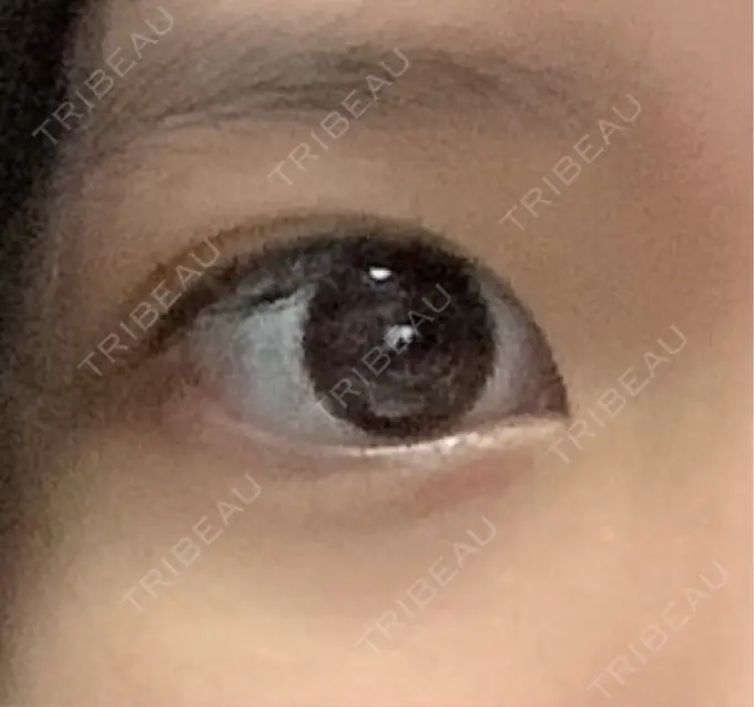 クマ治療 R Beauty CLINIC 銀座院 BEFORE メイン用