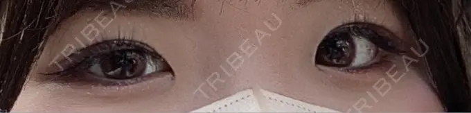 二重埋没 R Beauty CLINIC 銀座院 BEFORE メイン用