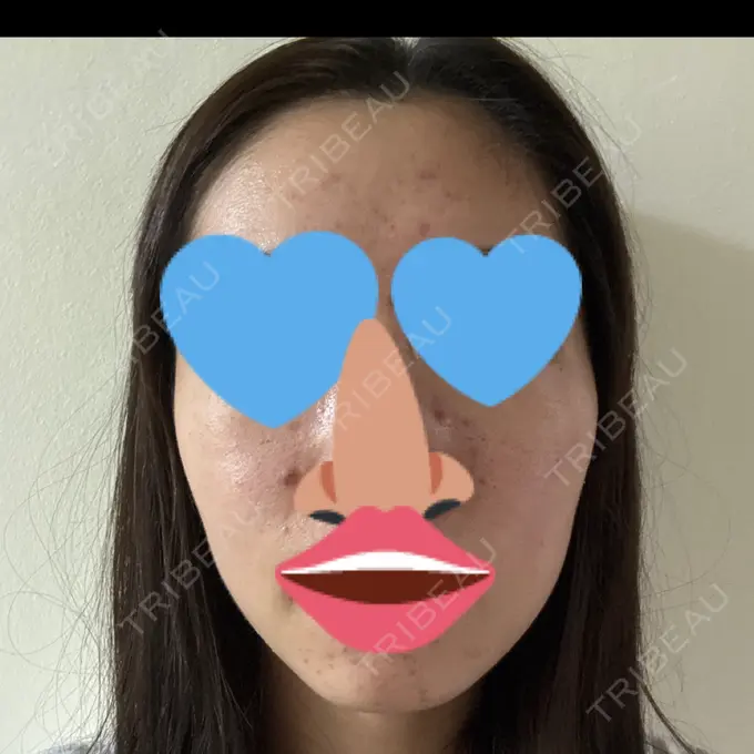 アグネス / ニキビ治療 日本ウェルネス再生クリニック BEFORE メイン用