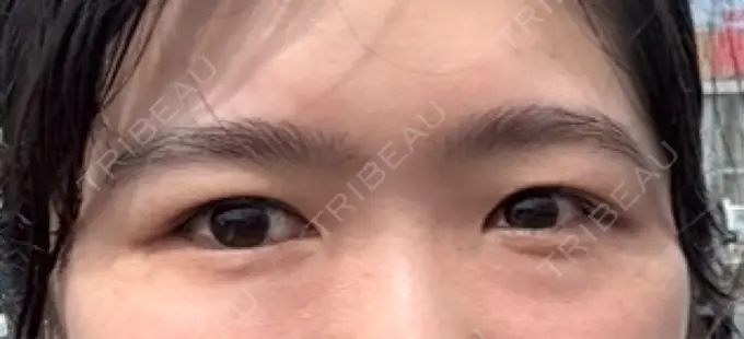 クマ治療 / 下まぶたの脂肪取り RIVER CLINIC（リバークリニック） BEFORE メイン用