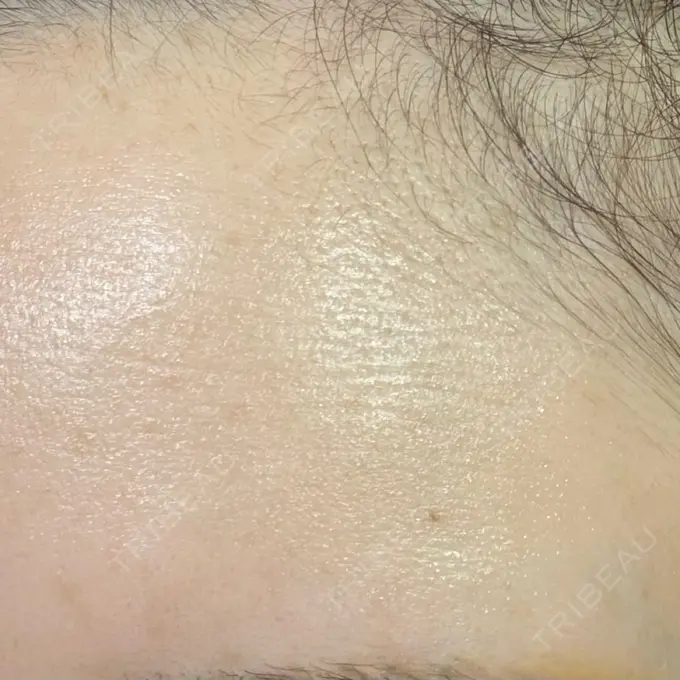 ルメッカ 東京美容外科 秋田院 BEFORE メイン用