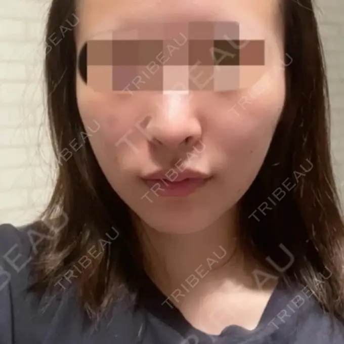 ほくろ・いぼ切除（肌） / ヒアルロン酸注入（あご） NARU Beauty Clinic 【ナルクリ】 水戸院 BEFORE メイン用